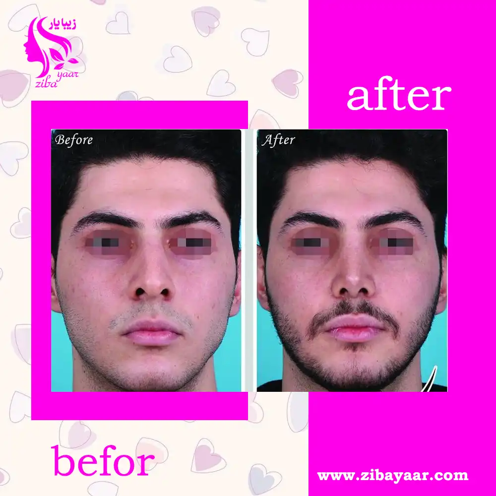نمونه جراحی بینی علیرضا سنمار
